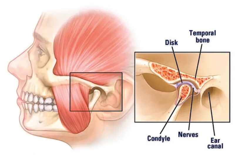 Jaw-joint anatomy diagram showing chewing muscles and an enlarged joint view with the disc and condyle