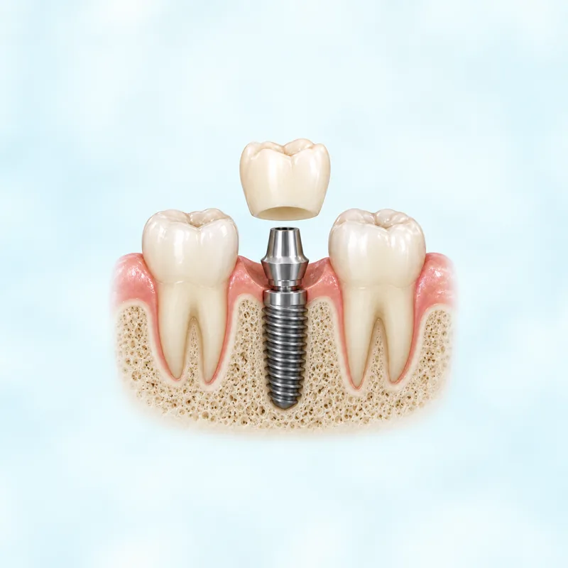 Illustration of a provisional crown above an implant abutment; loading suitability requires assessment