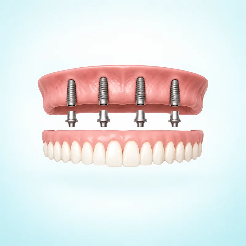 Illustration of a full dental prosthesis above four implant supports