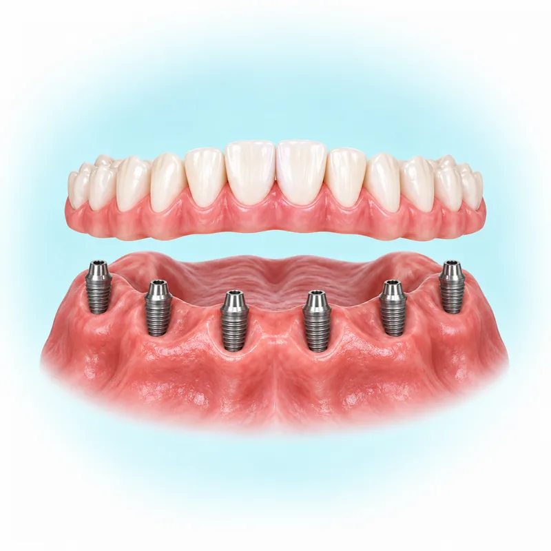Illustration of a complete dental prosthesis above six lower-arch implant supports