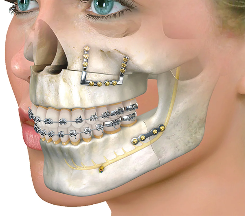 Illustration of jaw reconstruction with plates and screws in oral and maxillofacial surgery